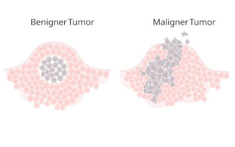 malignomausschluss|Diagnose von malignen Tumoren